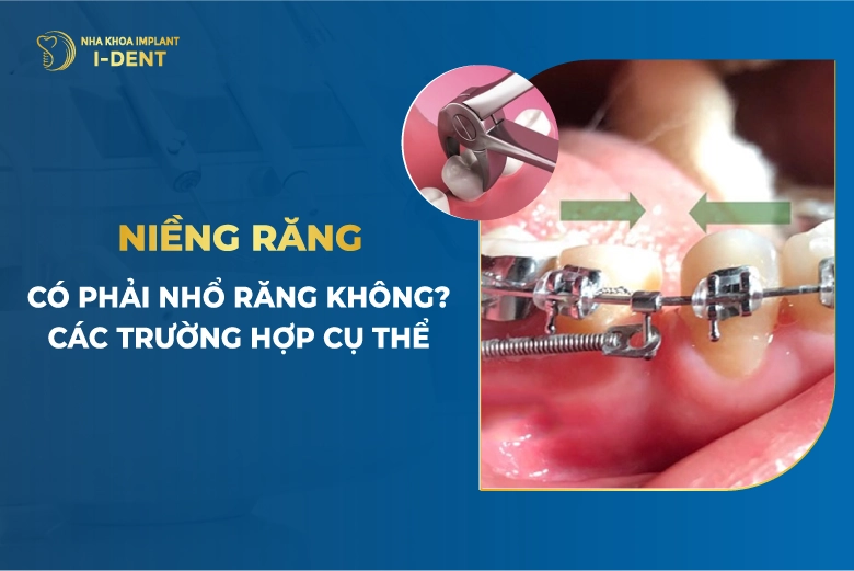 Niềng Răng Có Phải Nhổ Răng Không?