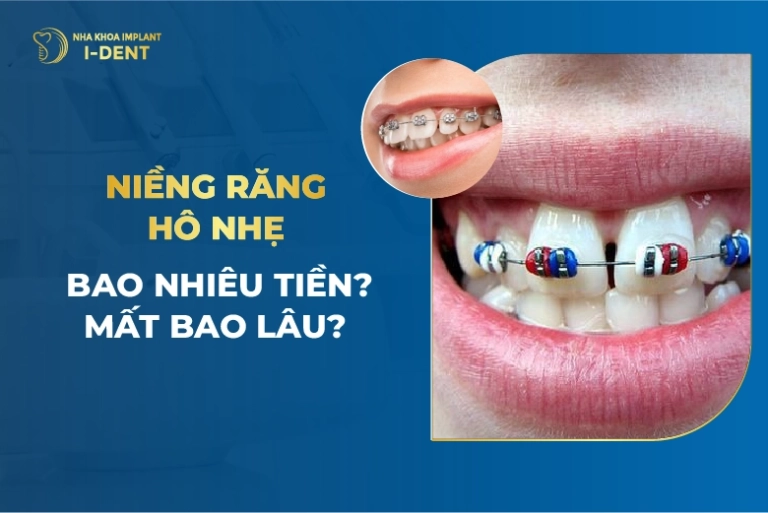Niềng Răng Hô: Quy Trình Và Các Phương Pháp Thực Hiện