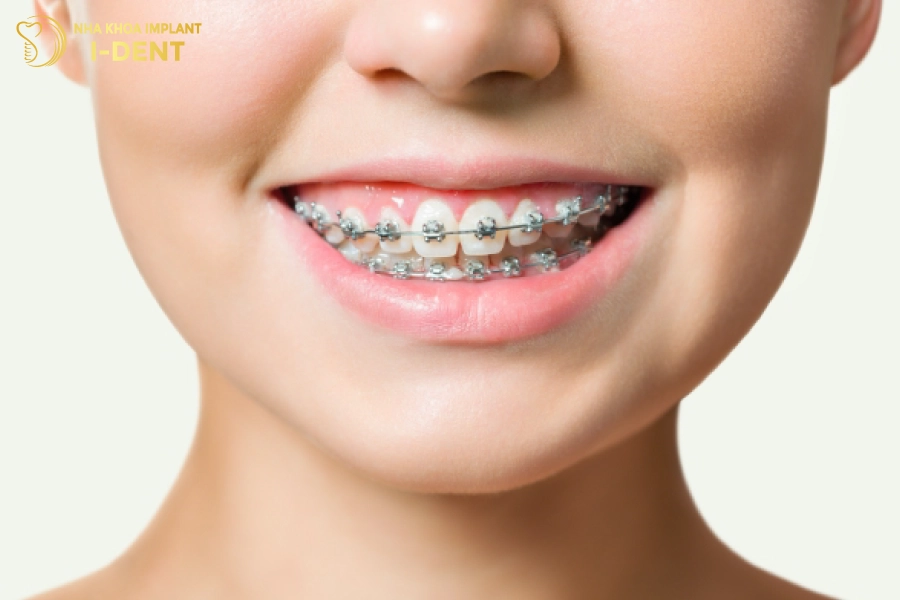 Niềng răng có thể điều chỉnh lại khớp cắn và cải thiện tình trạng móm