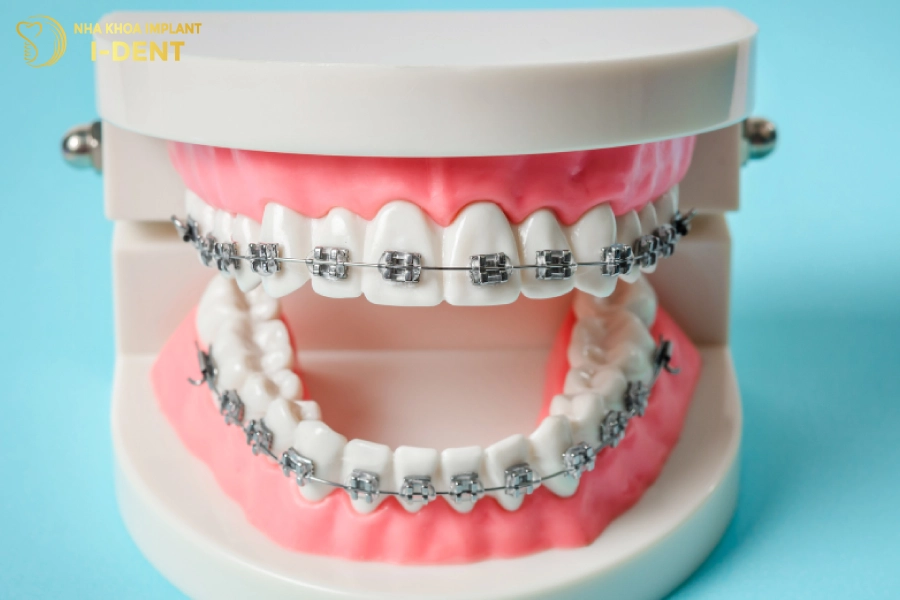 Niềng răng giúp điều chỉnh răng thẳng đều và chuẩn khớp cắn