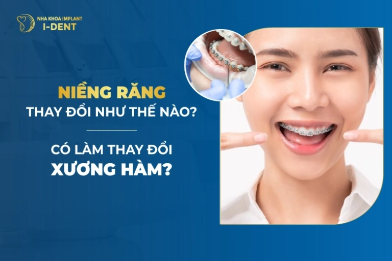 niềng răng có thay đổi xương hàm