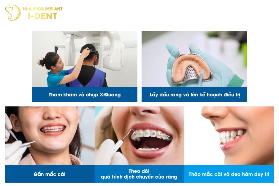 Quy trình niềng răng tại nha khoa I-DENT