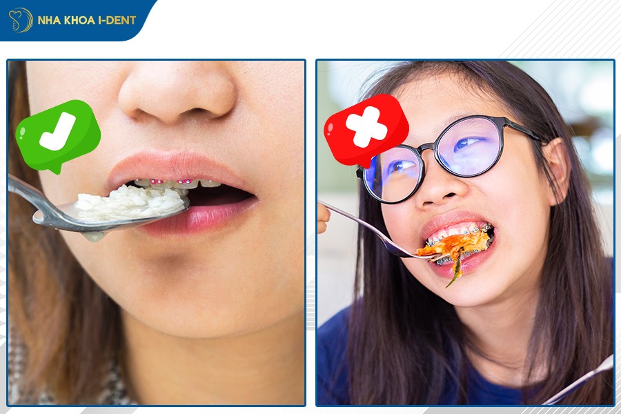 cách vệ sinh răng khi niềng