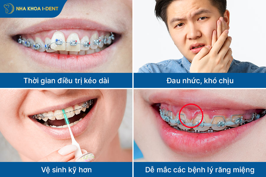 có nên đi niềng răng