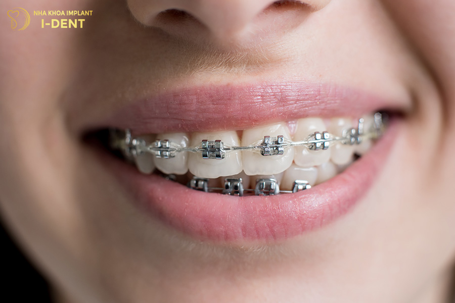 tác hại của niềng răng