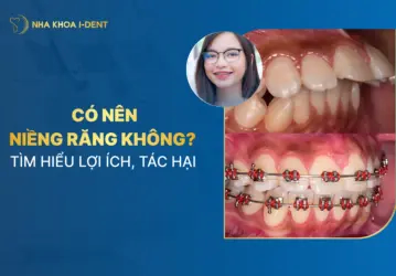 Có Nên Niềng Răng Không? Tìm Hiểu Lợi Ích, Tác Hại
