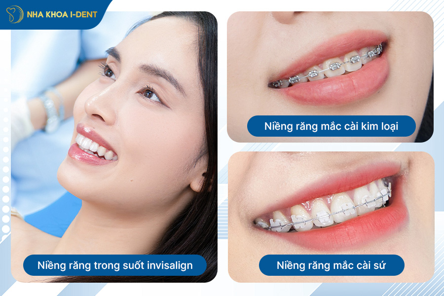 có nên niềng răng