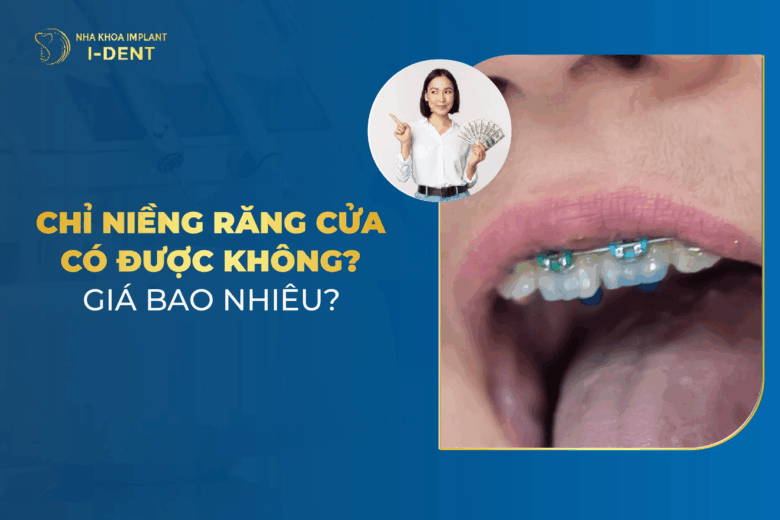 Chỉ Niềng 2 Răng Cửa Có Được Không? Giá Bao Nhiêu?