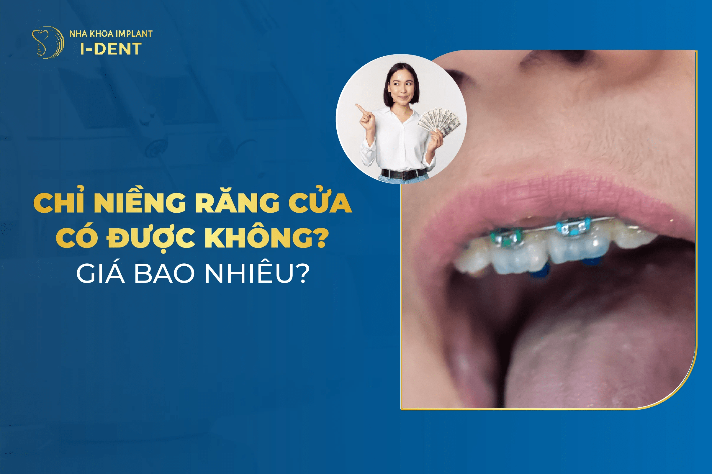 Chỉ Niềng Răng Cửa Có Được Không? Giá Bao Nhiêu?