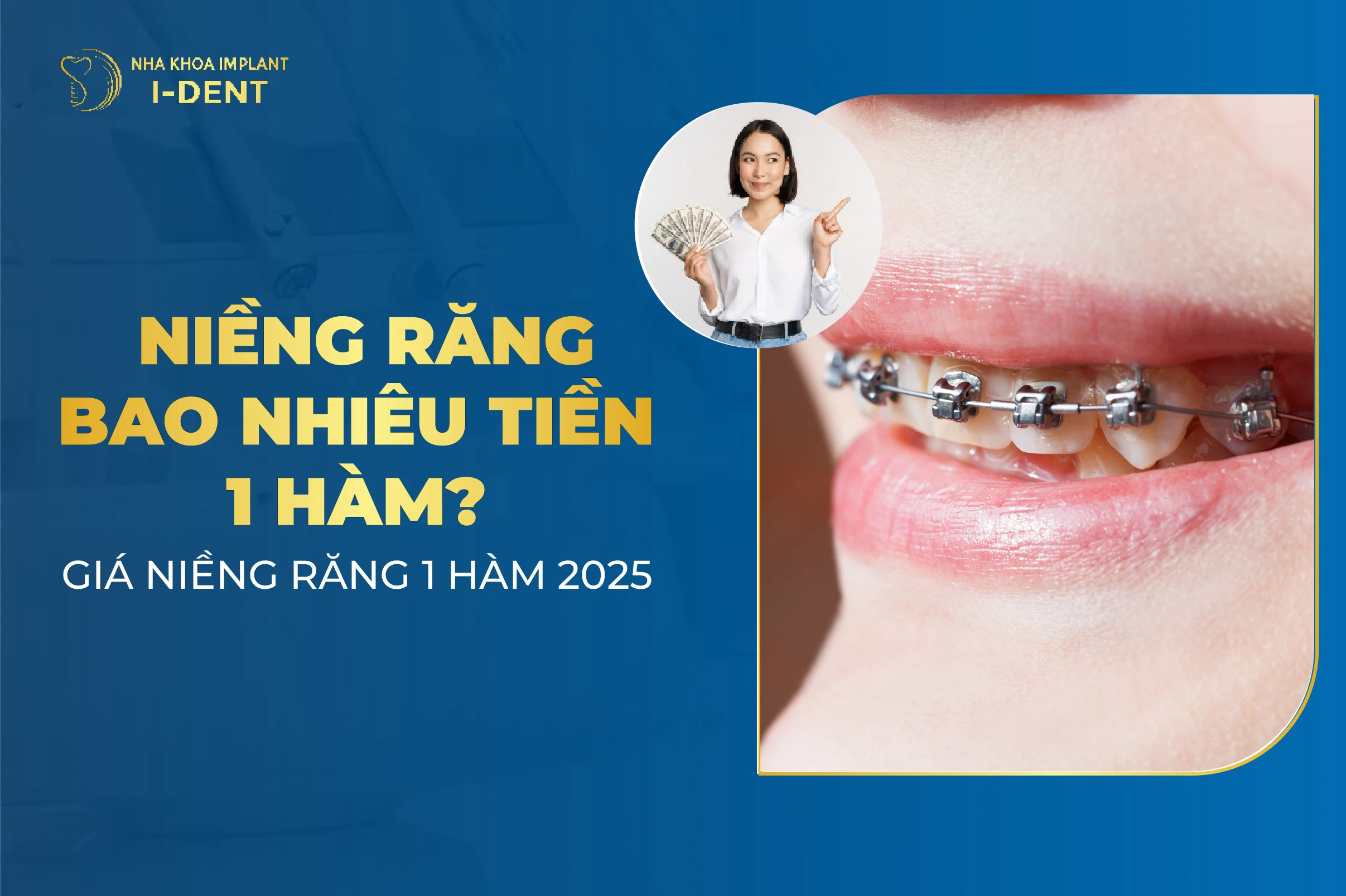 Niềng Răng Bao Nhiêu Tiền 1 Hàm? Giá Niềng Răng 1 Hàm 2025