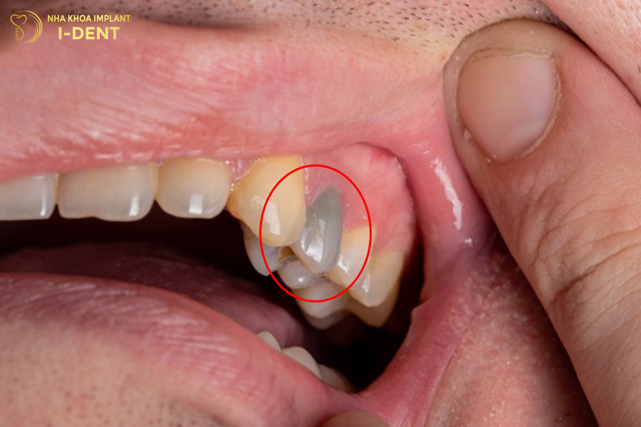 tác hại của niềng răng
