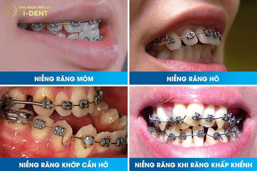 Niềng răng có thể giúp cải thiện phần nào tình trạng lệch mặt