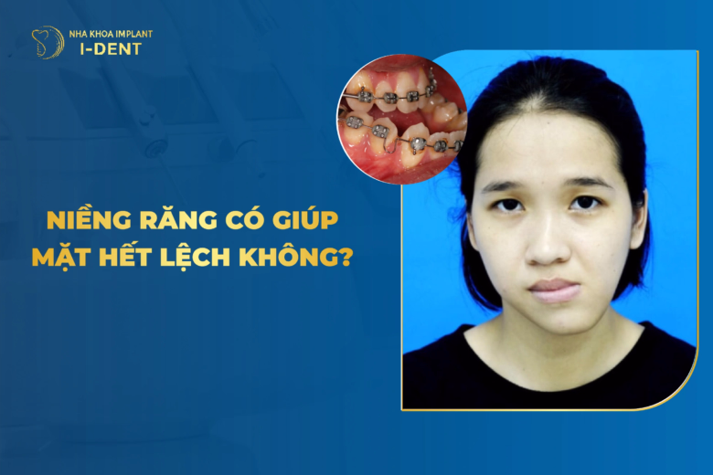 niềng răng có giúp mặt hết lệch không