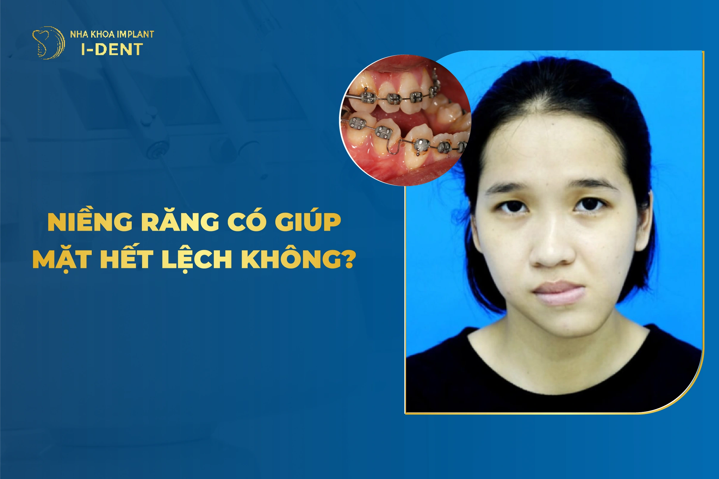 Niềng Răng Có Giúp Mặt Hết Lệch Không?
