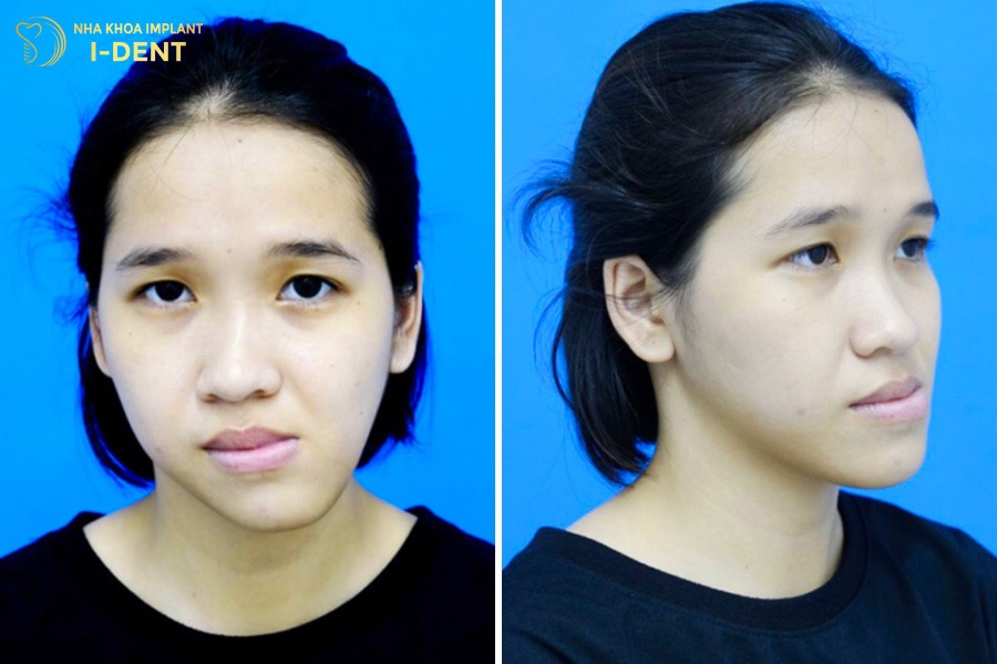 Mặt bị lệch ảnh hưởng nhiều đến sự tự tin