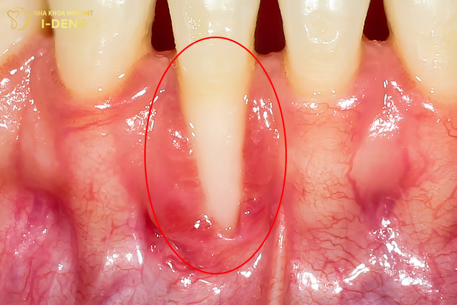 tác hại của niềng răng