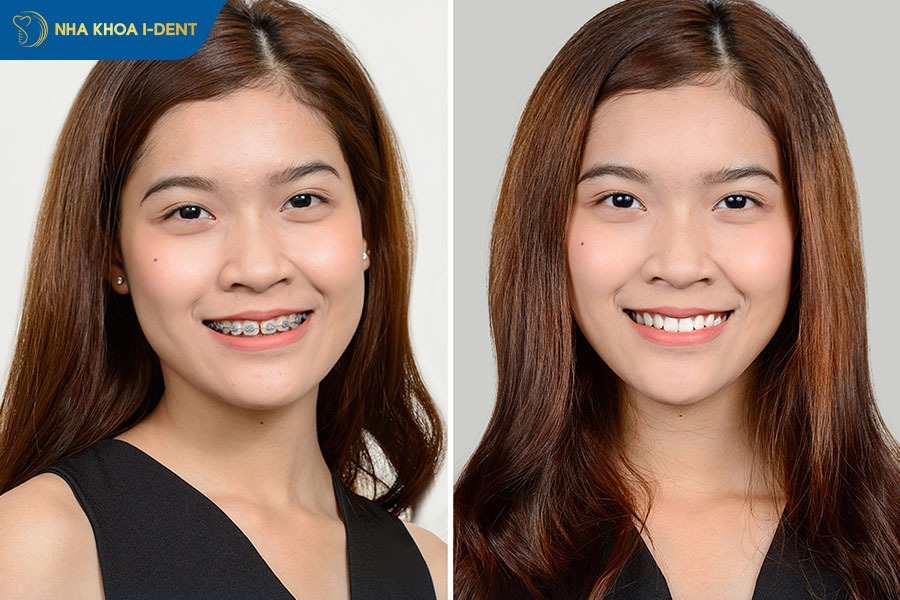 niềng răng có thay đổi xương hàm