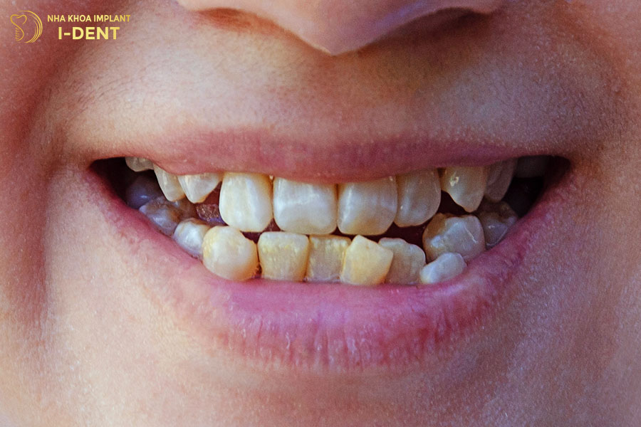 tác hại của niềng răng