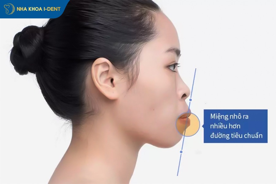 niềng răng kéo hàm