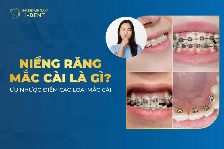 Niềng Răng Mắc Cài Là Gì? Ưu Nhược Điểm Các Loại Mắc Cài? Giá Niềng