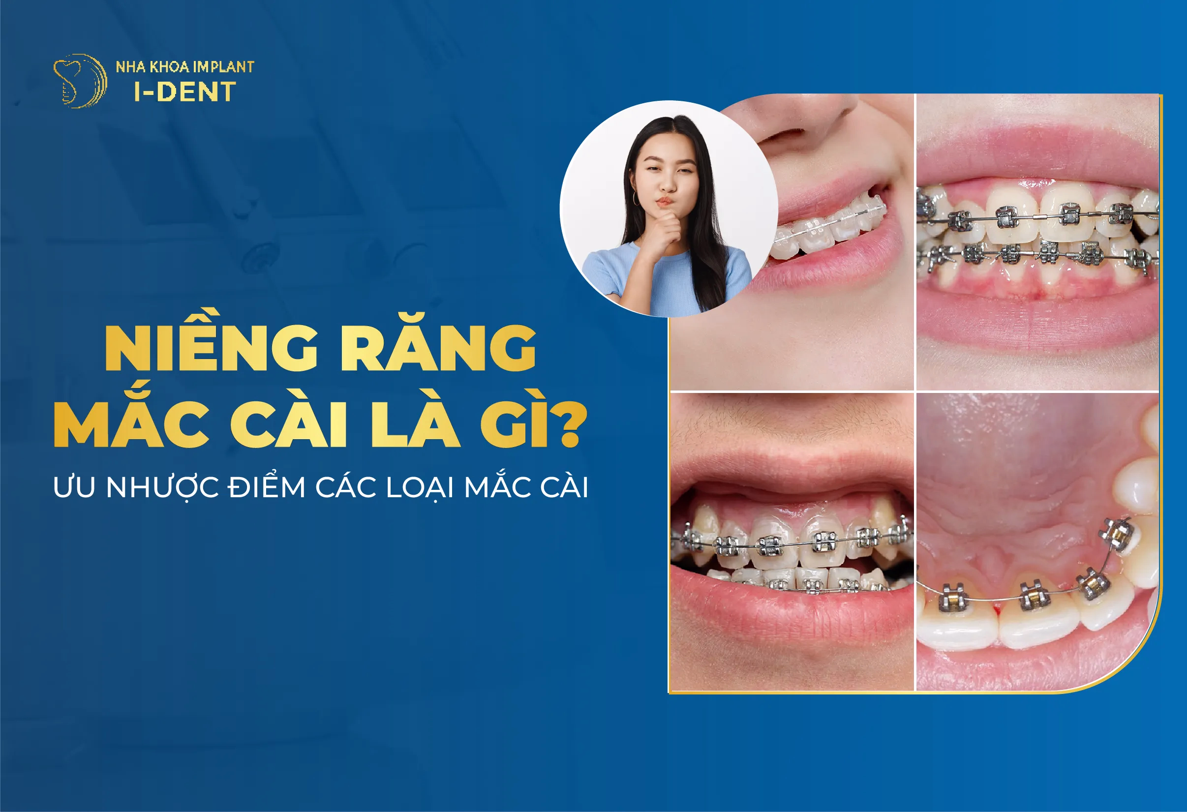 Niềng Răng Mắc Cài Là Gì? Các Loại Mắc Cài? Ưu, Nhược Điểm