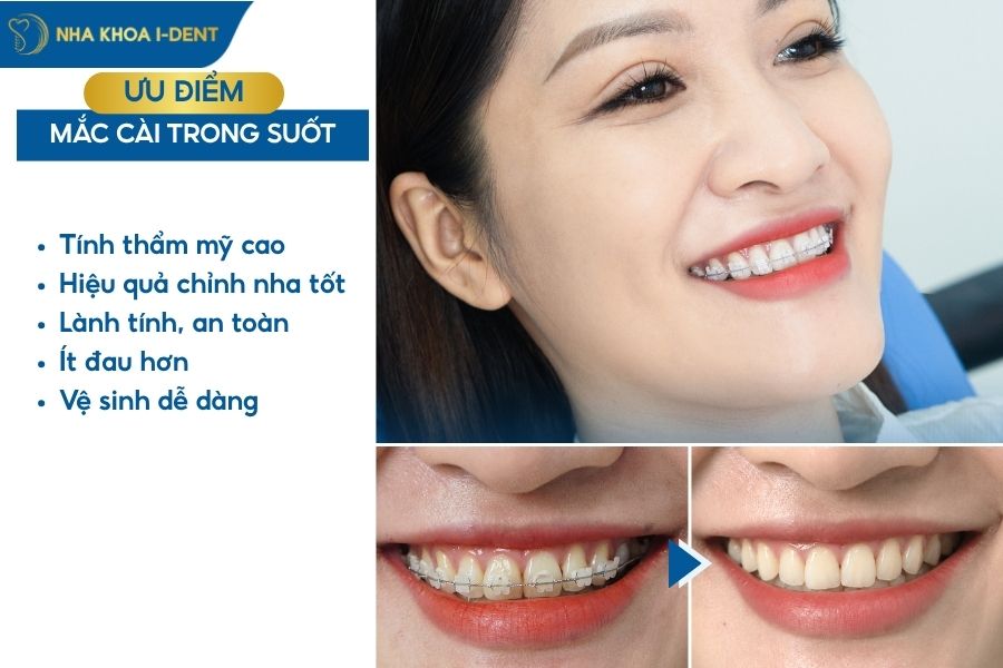 niềng răng mắc cài trong suốt