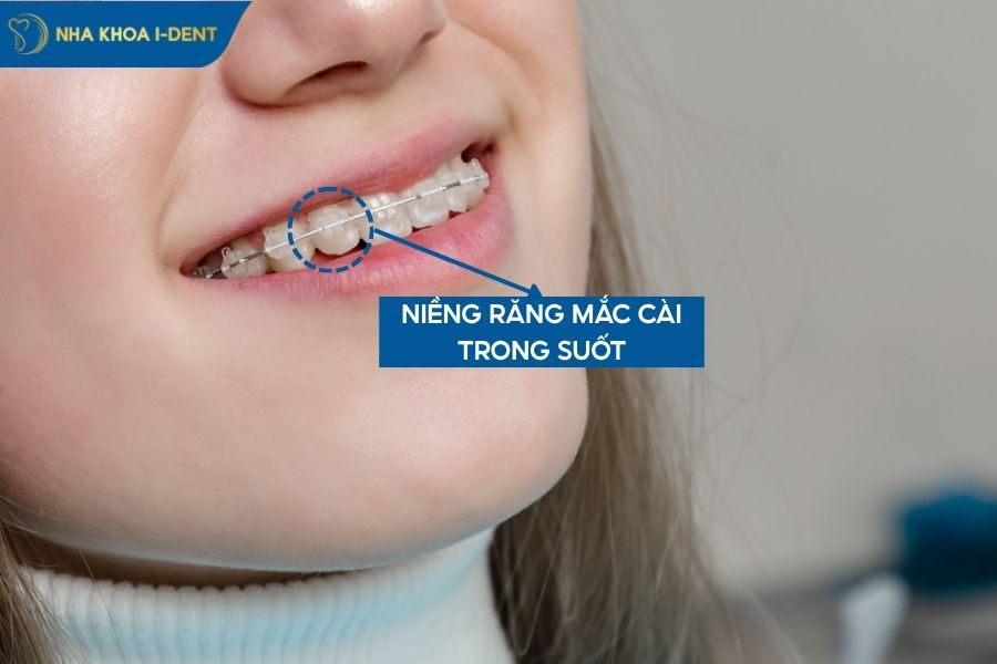niềng răng mắc cài sứ trong suốt