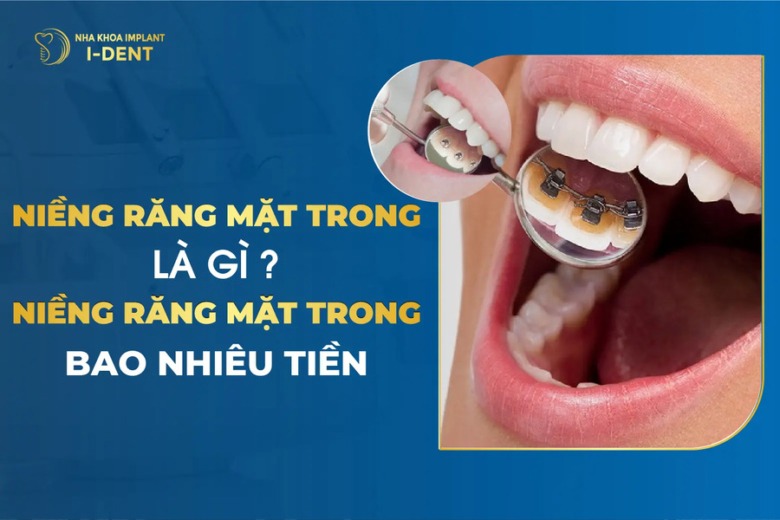 Niềng Răng Mặt Trong Là Gì? Ưu Nhược Điểm Và Chi Phí