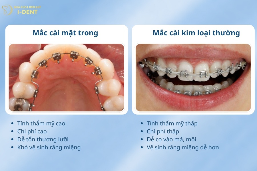 niềng răng mặt trong có tốt không