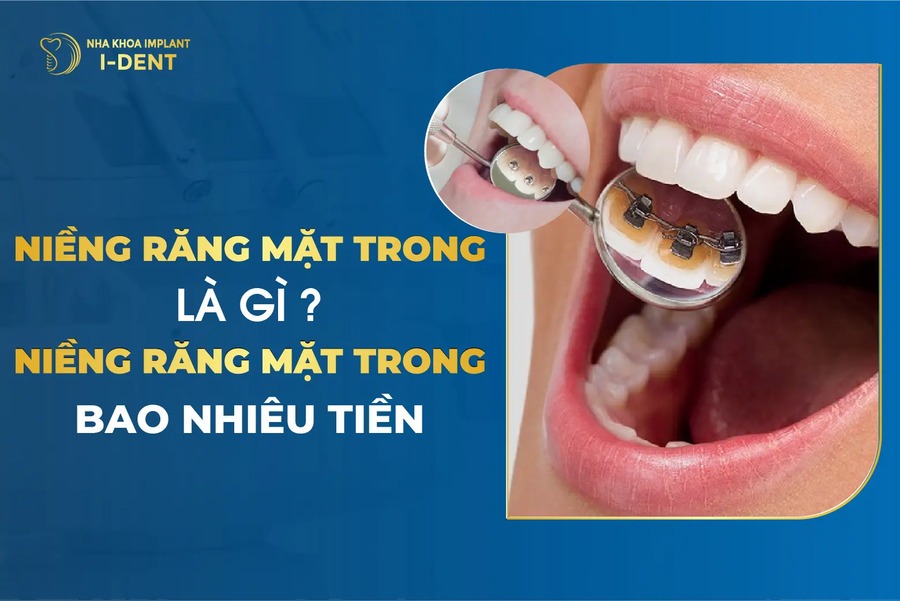 Niềng Răng Mặt Trong Là Gì? Ưu Nhược Điểm Và Chi Phí