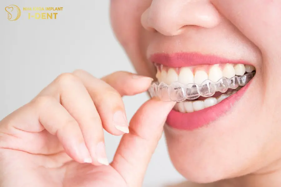 Niềng răng thưa bằng khay trong suốt