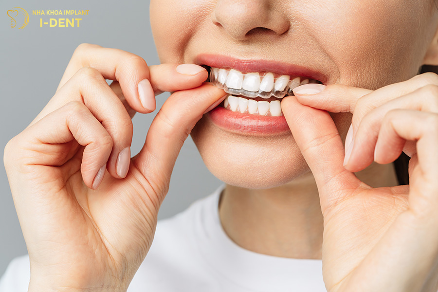 niềng răng có tác dụng gì