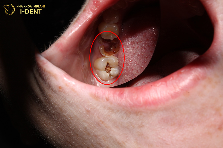 tác hại của niềng răng