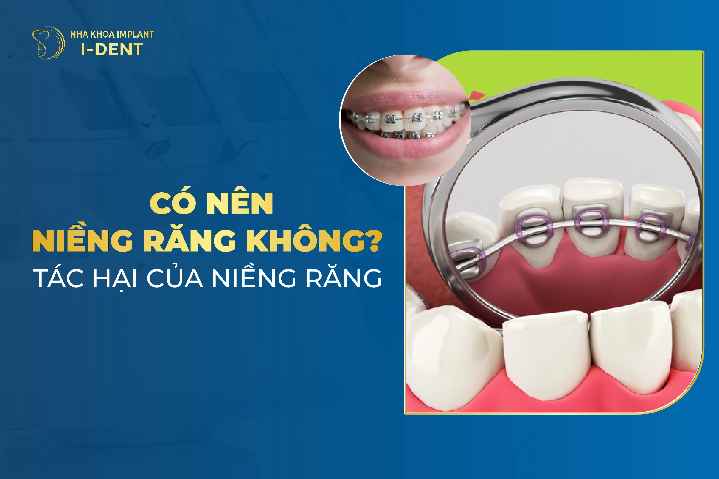 Có Nên Niềng Răng Không? 11 Tác Hại Của Niềng Răng