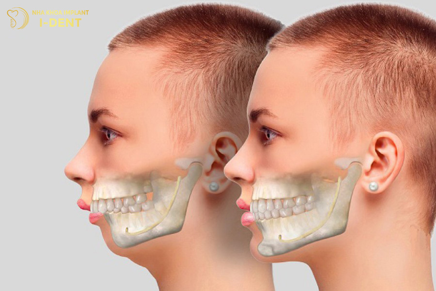 tác hại của niềng răng