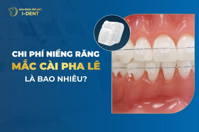 Chi Phí Niềng Răng Mắc Cài Pha Lê Là Bao Nhiêu