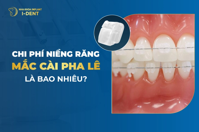 Chi Phí Niềng Răng Mắc Cài Pha Lê Là Bao Nhiêu?