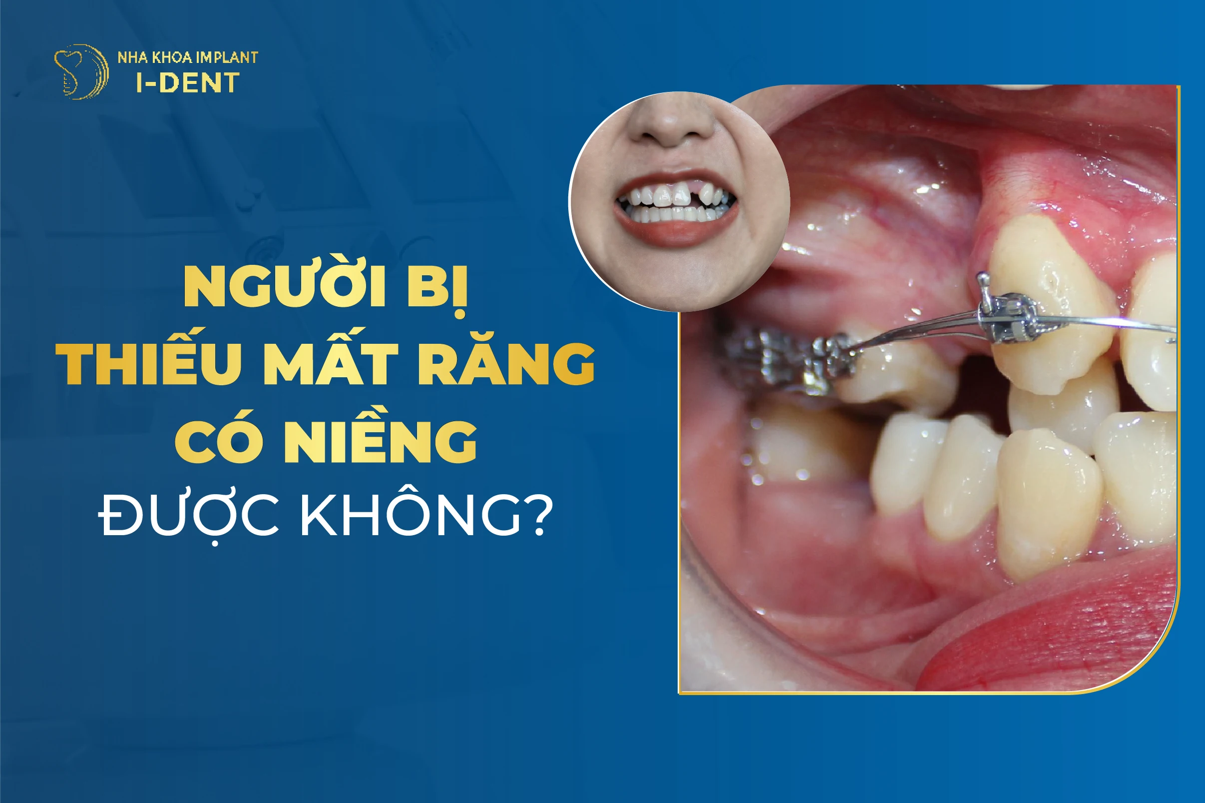 Người Bị Mất Răng Có Niềng Được Không?