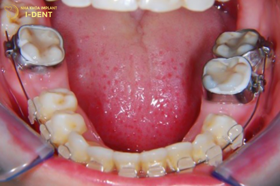 Mất răng hàm có thể niềng răng được