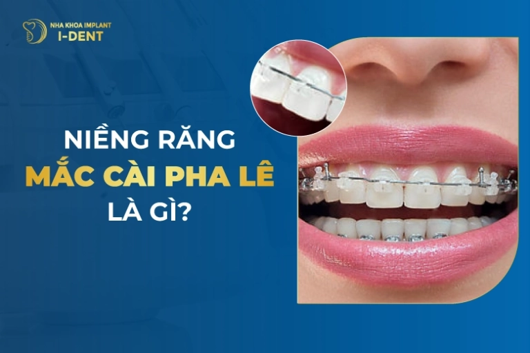 Niềng Răng Mắc Cài Pha Lê Là Gì?