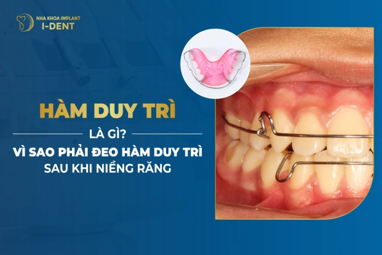 Hàm Duy Trì Là Gì? Vì Sao Phải Đeo Hàm Duy Trì Sau Khi Niềng Răng