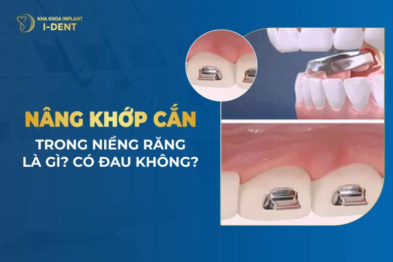 nâng khớp niềng răng