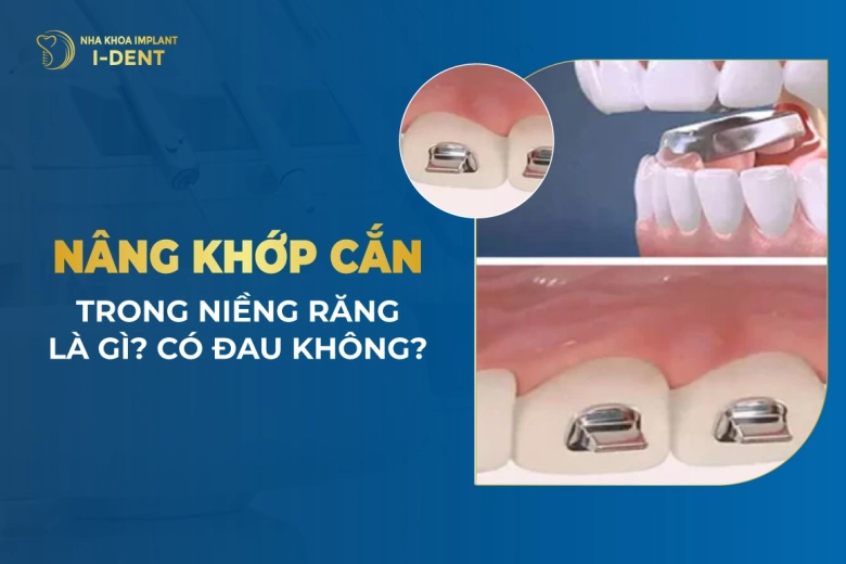 Nâng Khớp Cắn Trong Niềng Răng Là Gì? Có Đau Không?