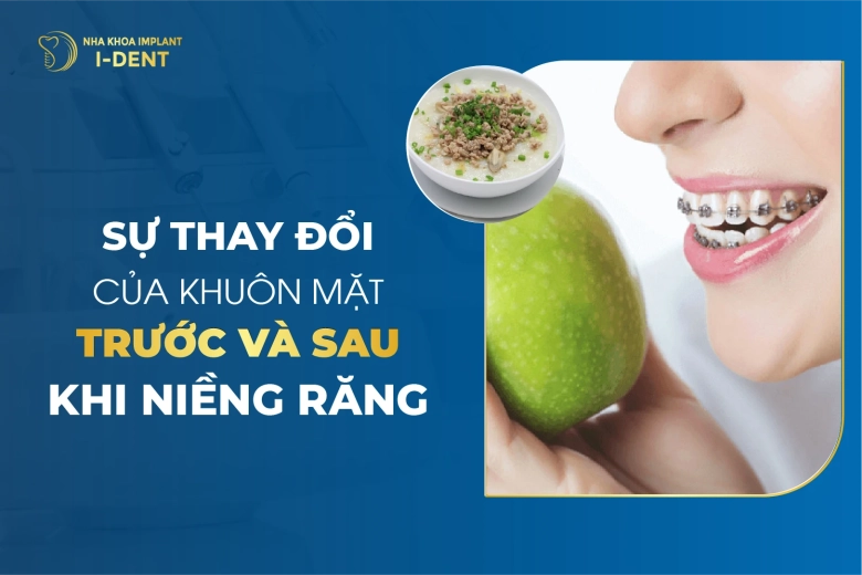 Niềng Răng Ăn Gì Và Kiêng Gì Để Tốt Cho Sức Khỏe Răng Miệng