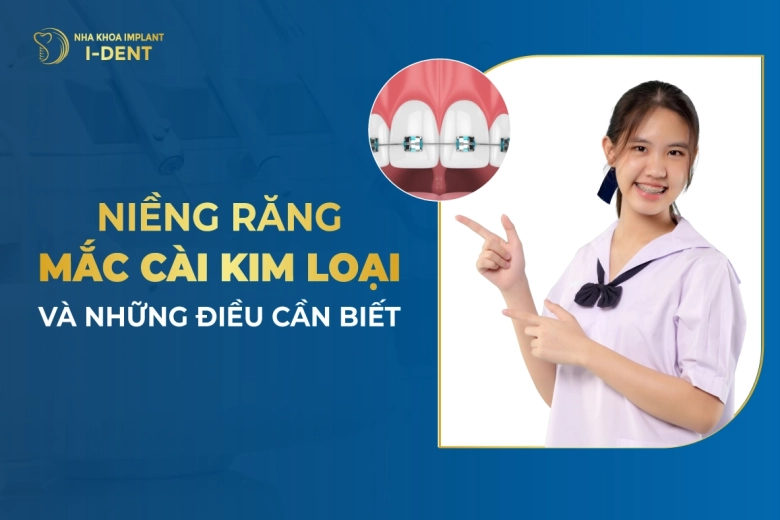 Niềng Răng Mắc Cài Kim Loại Và Những Điều Cần Biết