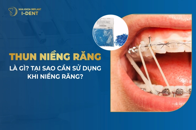 Đeo Dây Thun Niềng Răng Có Tác Dụng Gì? Các Loại Chun