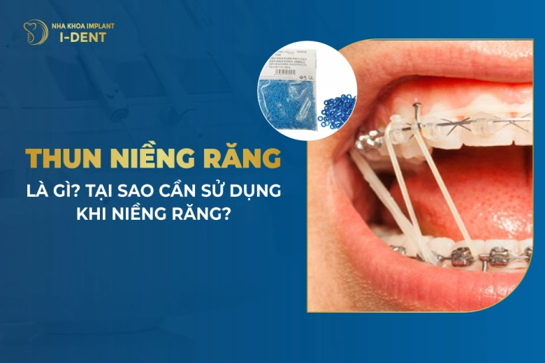 Thun Niềng Răng Là Gì? Tại Sao Cần Sử Dụng Khi Niềng Răng?