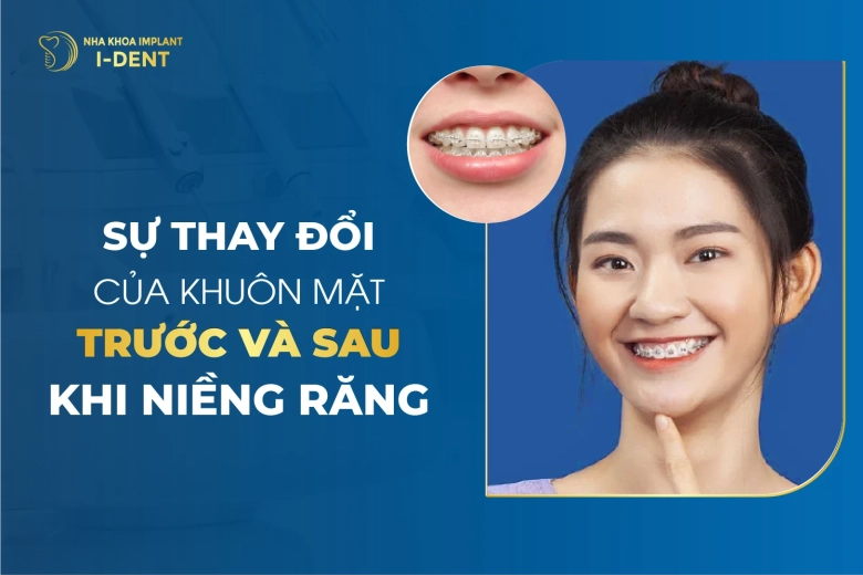 Trước Và Sau Khi Niềng Răng Khuôn Mặt Thay Đổi Như Thế Nào?