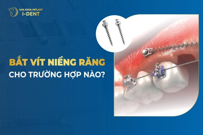 Bắt Vít Niềng Răng Là Gì? Tại Sao Cần Bắt Vít Niềng Răng?