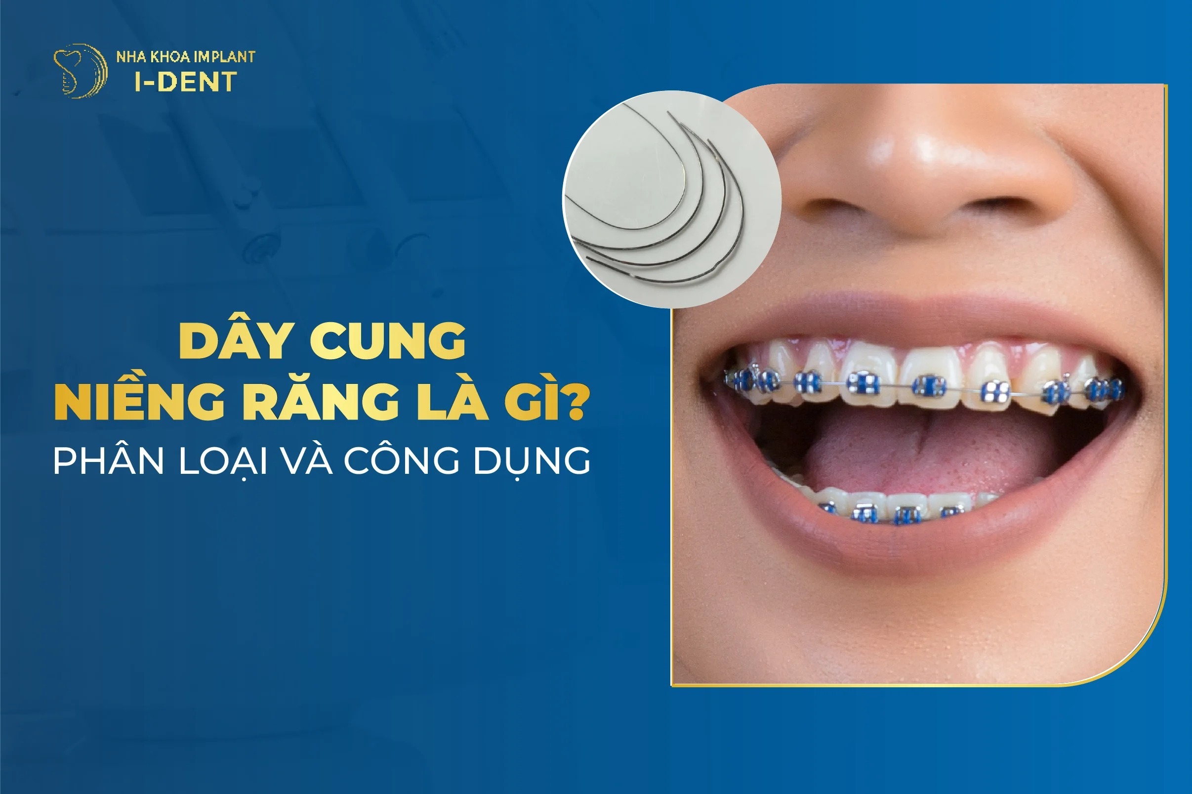 Dây Cung Niềng Răng Là Gì? Phân Loại Và Công Dụng